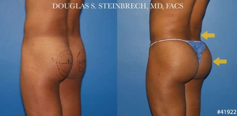 Gluteal augmentation revision to enhance the buttocks by Dr. Steinbrech
