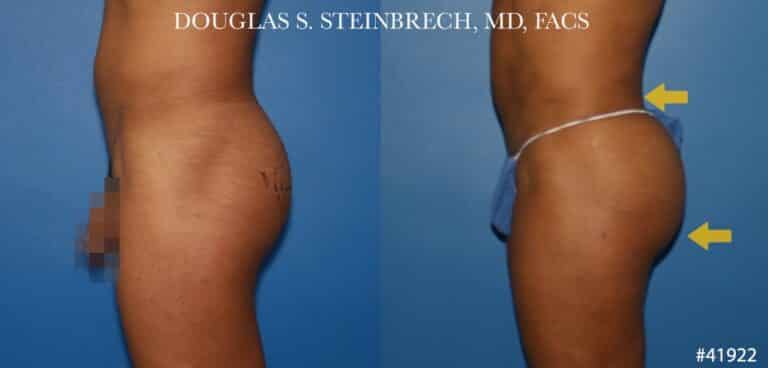 Gluteal augmentation revision to enhance the buttocks by Dr. Steinbrech