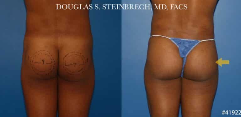 Gluteal augmentation revision to enhance the buttocks by Dr. Steinbrech