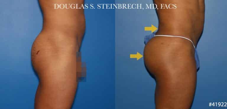 Gluteal augmentation revision to enhance the buttocks by Dr. Steinbrech