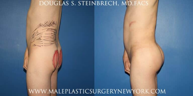Gluteal implants with fat injections and liposuction by Dr. Steinbrech