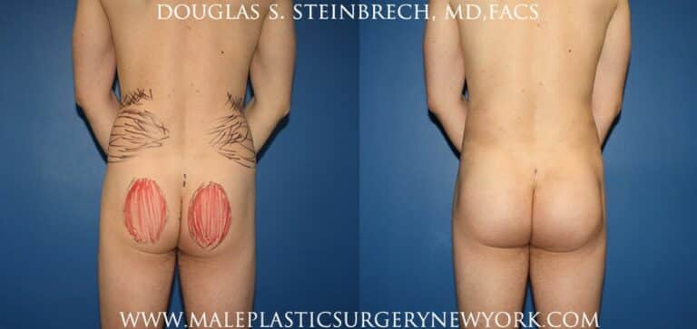 Gluteal implants with fat injections and liposuction by Dr. Steinbrech