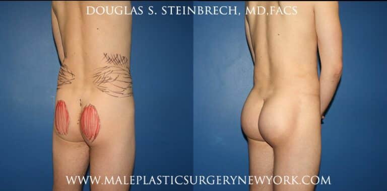Gluteal implants with fat injections and liposuction by Dr. Steinbrech