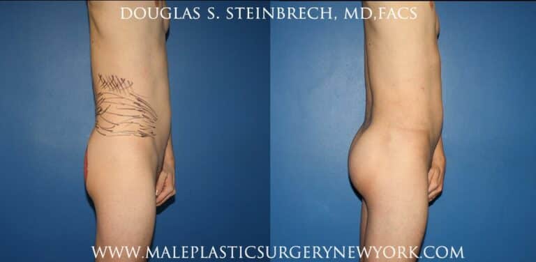 Gluteal implants with fat injections and liposuction by Dr. Steinbrech
