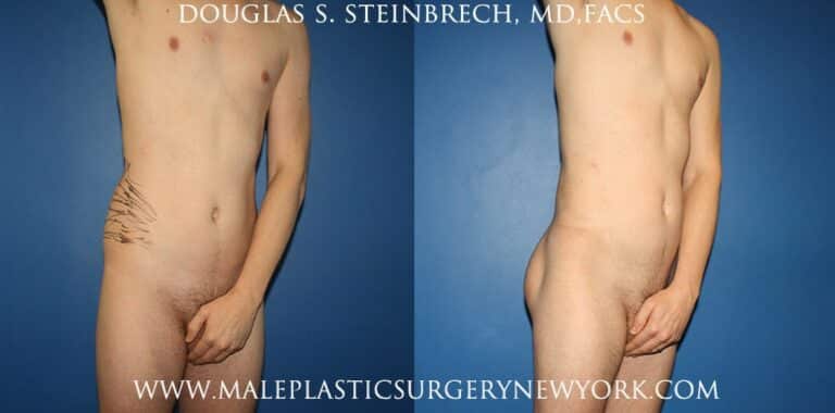 Gluteal implants with fat injections and liposuction by Dr. Steinbrech