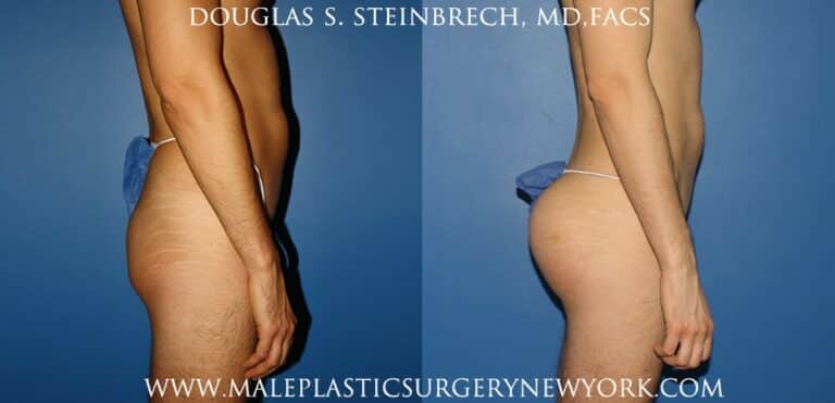 Gluteal implants for buttock augmentation by Dr. Steinbrech