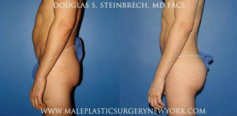 Gluteal implants for buttock augmentation by Dr. Steinbrech