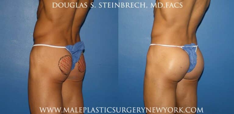 Gluteal augmentation for fuller buttocks by Dr. Steinbrech