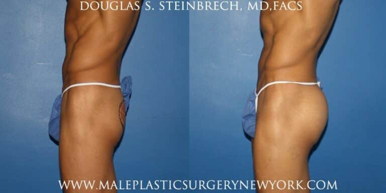 Gluteal augmentation for fuller buttocks by Dr. Steinbrech