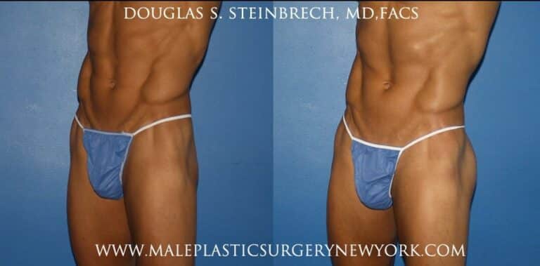 Gluteal augmentation for fuller buttocks by Dr. Steinbrech