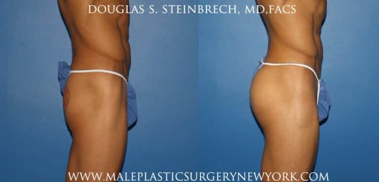Gluteal augmentation for fuller buttocks by Dr. Steinbrech