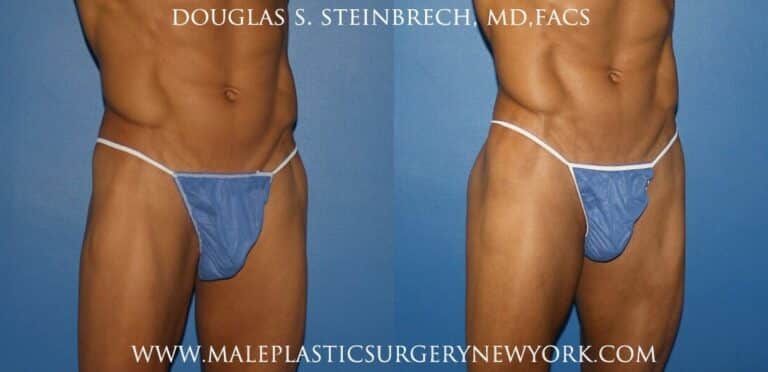 Gluteal augmentation for fuller buttocks by Dr. Steinbrech