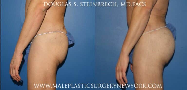 Gluteal implants with liposuction and fat injections by Dr. Steinbrech
