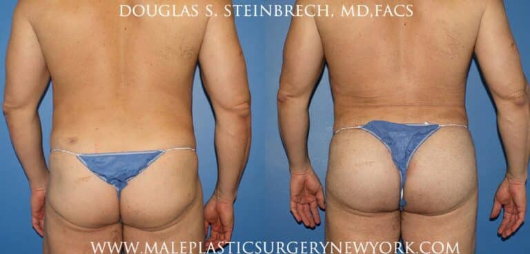 Gluteal implants with liposuction and fat injections by Dr. Steinbrech