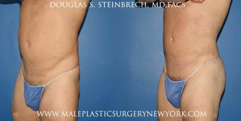 Gluteal implants with liposuction and fat injections by Dr. Steinbrech
