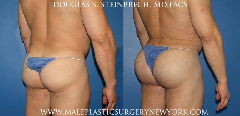 Gluteal implants with liposuction and fat injections by Dr. Steinbrech