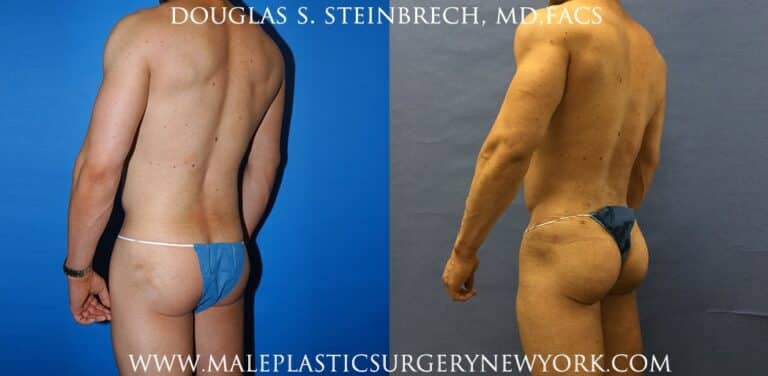 Gluteal implants for buttock augmentation by Dr. Steinbrech