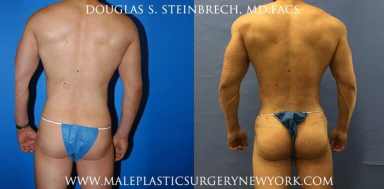 Gluteal implants for buttock augmentation by Dr. Steinbrech