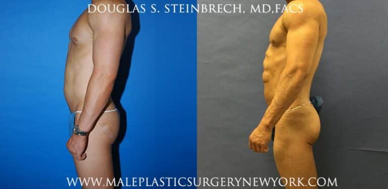 Gluteal implants for buttock augmentation by Dr. Steinbrech