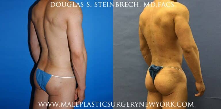 Gluteal implants for buttock augmentation by Dr. Steinbrech