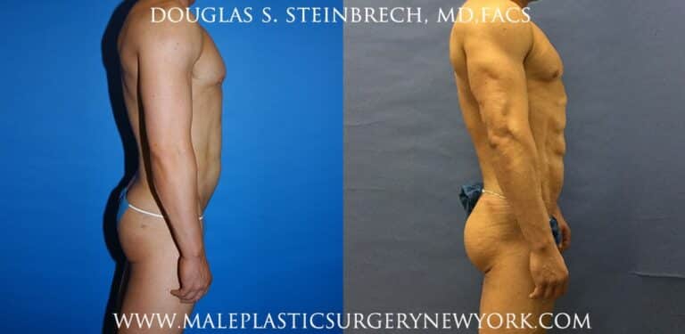 Gluteal implants for buttock augmentation by Dr. Steinbrech