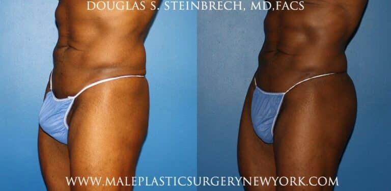 Gluteal implants to shape the buttocks by Dr. Steinbrech