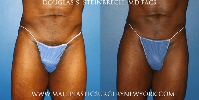 Gluteal implants to shape the buttocks by Dr. Steinbrech