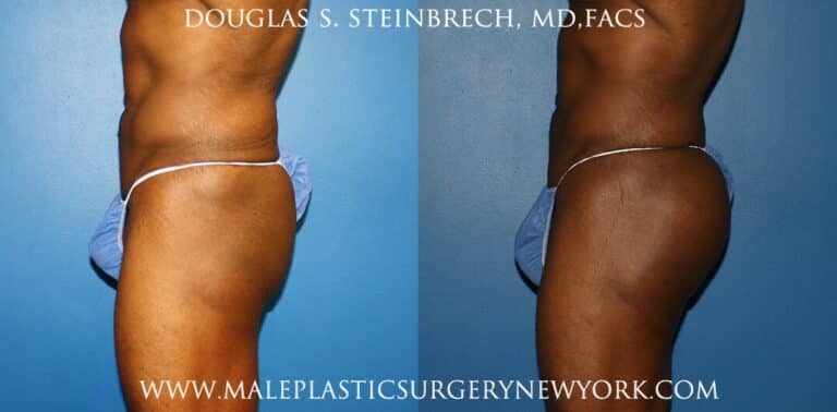 Gluteal implants to shape the buttocks by Dr. Steinbrech