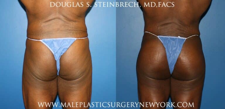 Gluteal implants to shape the buttocks by Dr. Steinbrech