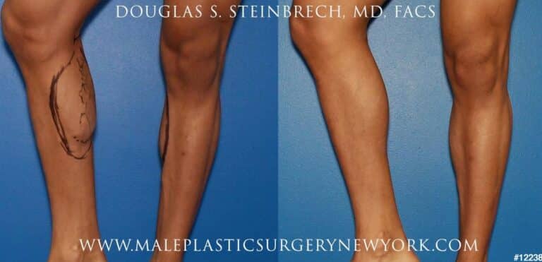 Implants for calf augmentation by Dr. Steinbrech