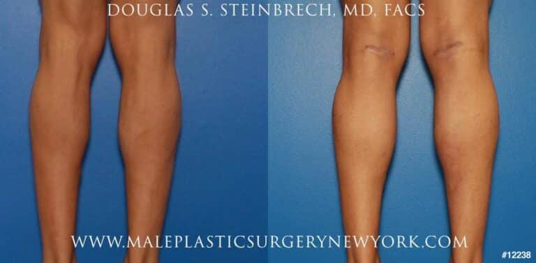 Implants for calf augmentation by Dr. Steinbrech