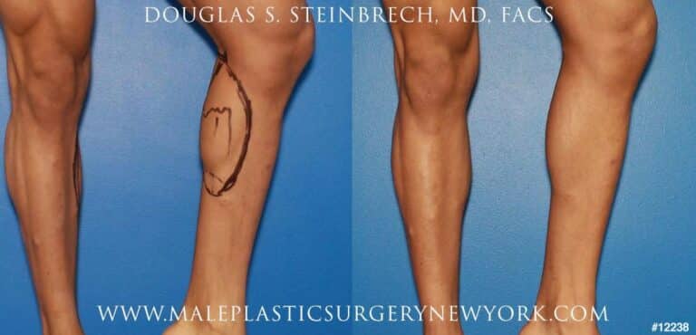 Implants for calf augmentation by Dr. Steinbrech