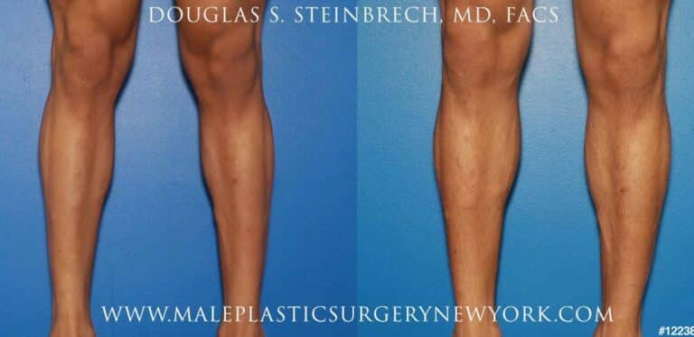 Implants for calf augmentation by Dr. Steinbrech