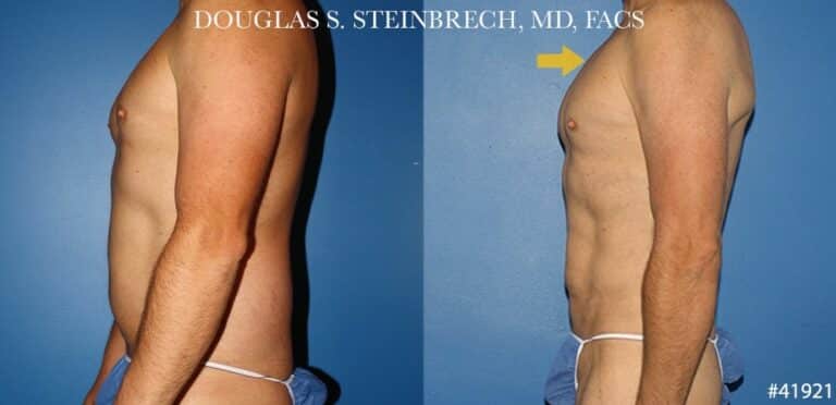 Liposuction with body banking to enhance the torso by Dr. Steinbrech