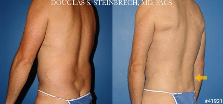 Liposuction with body banking to enhance the torso by Dr. Steinbrech