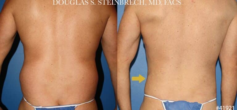 Liposuction with body banking to enhance the torso by Dr. Steinbrech