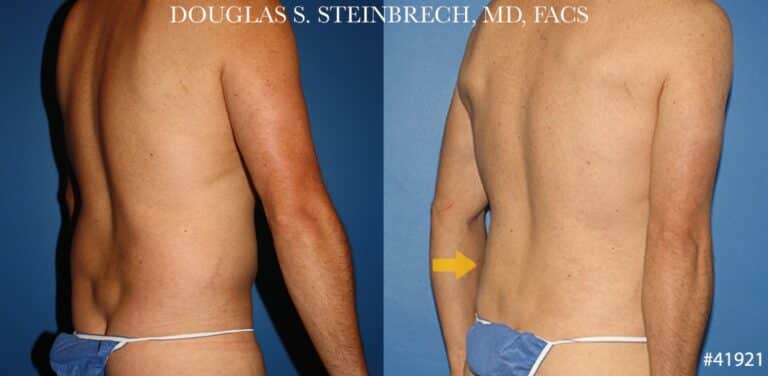 Liposuction with body banking to enhance the torso by Dr. Steinbrech