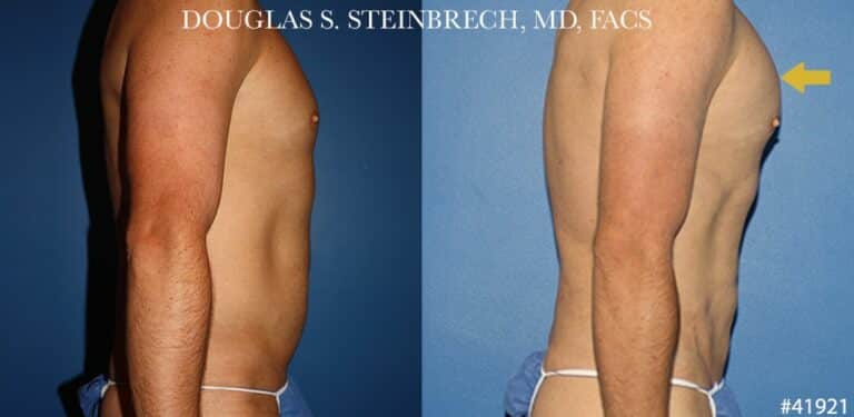 Liposuction with body banking to enhance the torso by Dr. Steinbrech