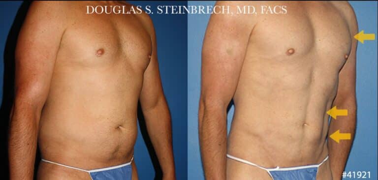 Liposuction with body banking to enhance the torso by Dr. Steinbrech
