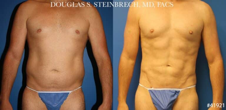 Liposuction with body banking to enhance the torso by Dr. Steinbrech