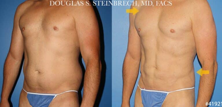 Liposuction with body banking to enhance the torso by Dr. Steinbrech