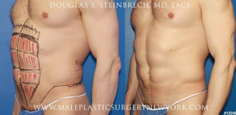 Liposuction for surfer abs by Dr. Steinbrech