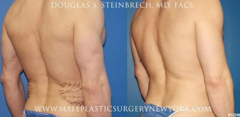 Liposuction for surfer abs by Dr. Steinbrech