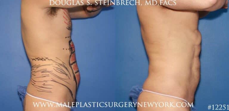Liposuction to create surfer abs by Dr. Steinbrech