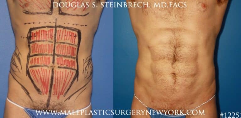 Liposuction to create surfer abs by Dr. Steinbrech