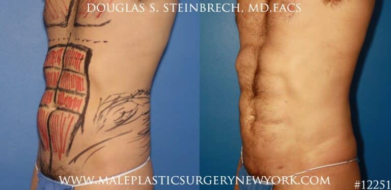 Liposuction to create surfer abs by Dr. Steinbrech