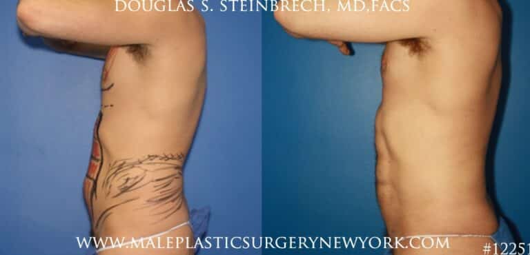 Liposuction to create surfer abs by Dr. Steinbrech