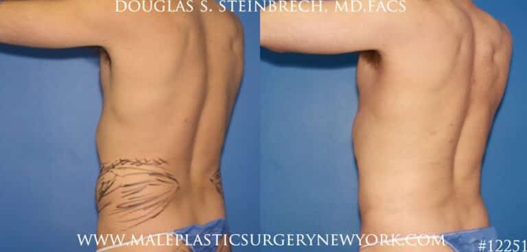 Liposuction to create surfer abs by Dr. Steinbrech