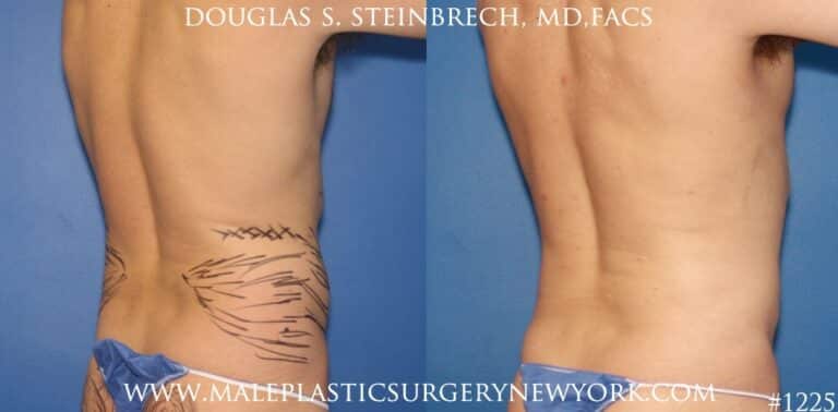 Liposuction to create surfer abs by Dr. Steinbrech