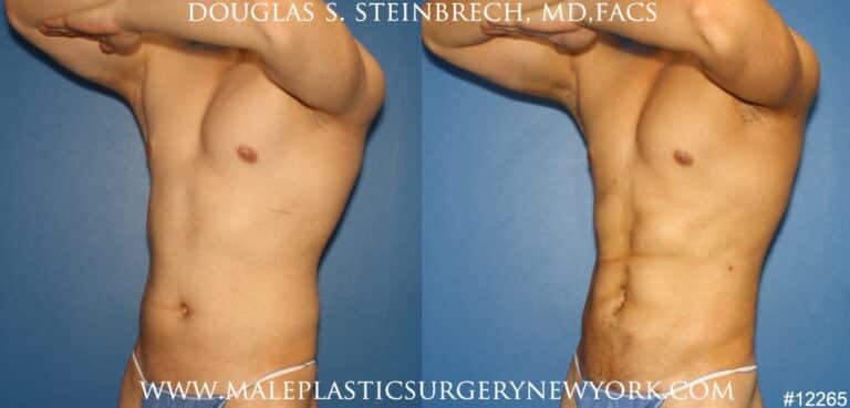 Liposuction to sculpt surfer abs by Dr. Steinbrech